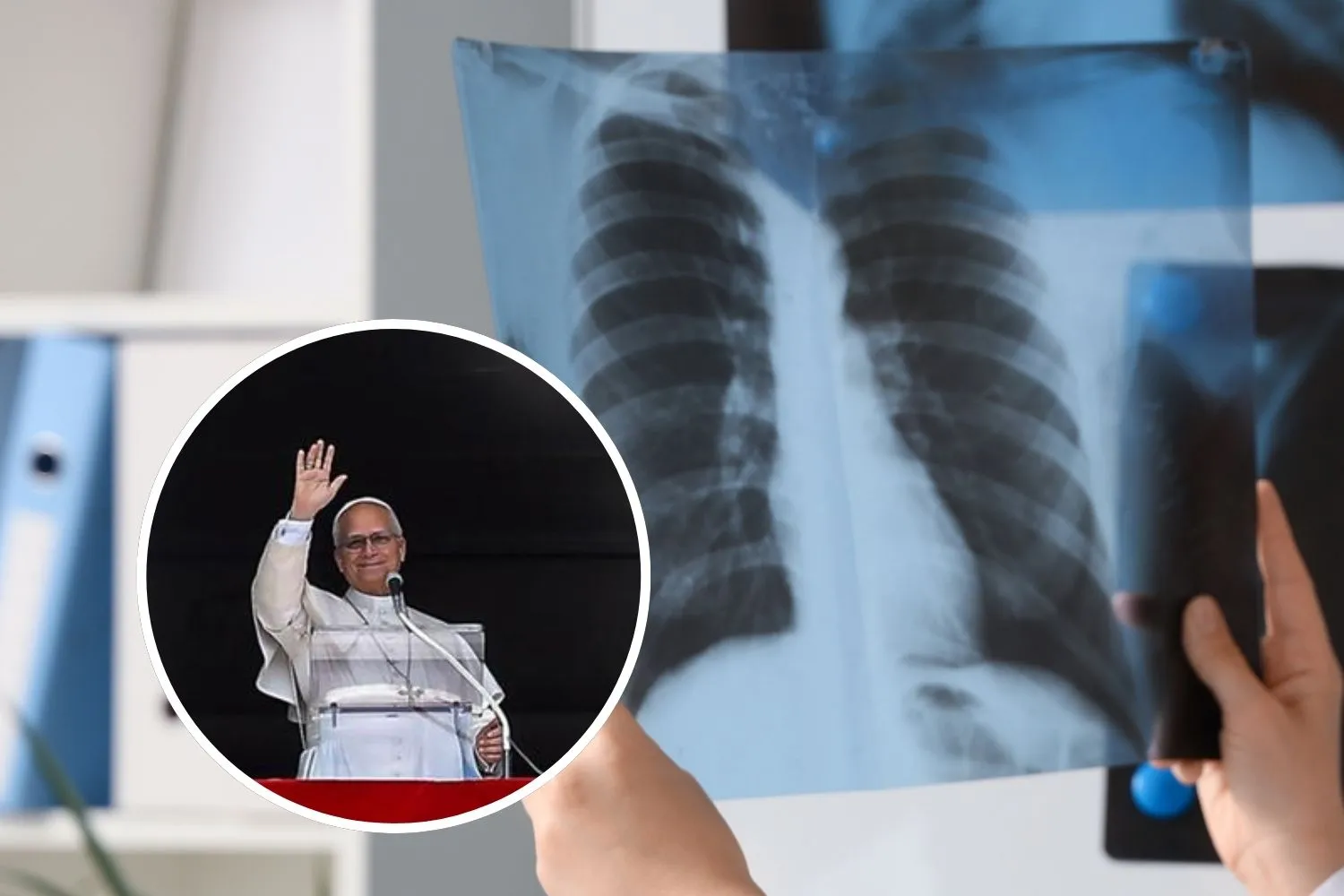 Un nodulo al polmone (come quello di Papa Leone) significa tumore? Dalla diagnosi alla chirurgia, quello che devi sapere